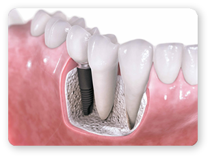 Implantul Dentar