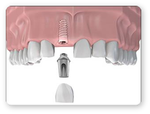 Etape Tratament Implant Dentar