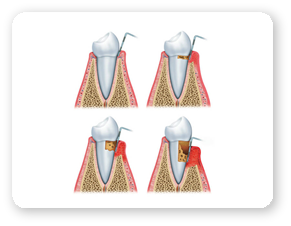 Parodontopatie Mobilitatea Dentara Tratament