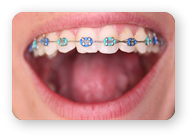 Aparat Dentar Fix