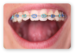 Ortodontie Aparate Dentare