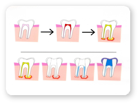 Tratament Endodontic - Scoaterea Nervului