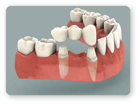 Lucrare Dentara - Coroane Ceramica